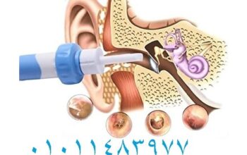 جهاز تنضيف الاذن بواسطة الشفط